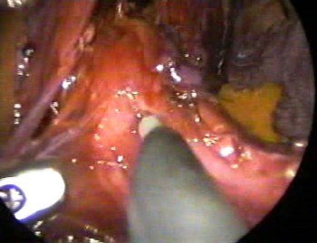 cardiomiotomia de heller por acalasia